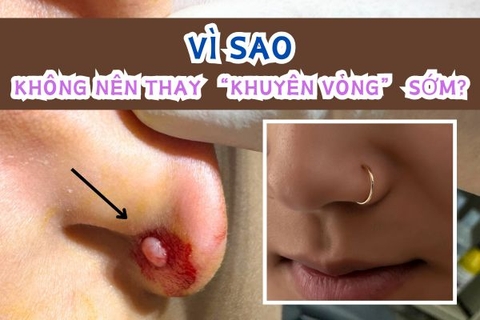 Tại sao không nên thay khuyên vòng sớm cho lỗ xỏ sụn?