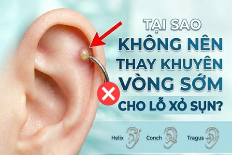 Tại sao không nên thay khuyên vòng sớm cho lỗ xỏ sụn?