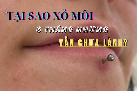 Tại sao xỏ khuyên môi 6 tháng nhưng vẫn chưa lành?