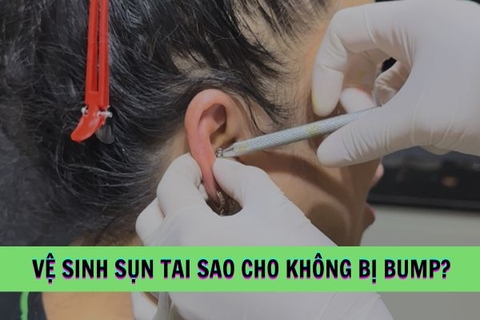 Vệ sinh lỗ xỏ sụn sao cho an toàn, không bị bump?