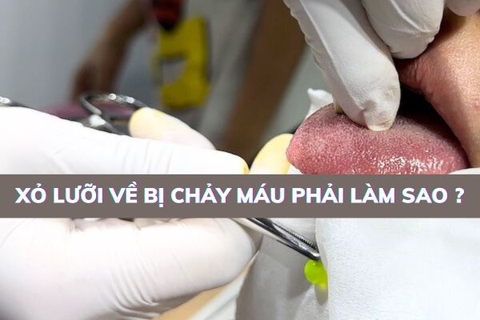 Xỏ khuyên lưỡi về nhà thì bị chảy máu phải làm sao?