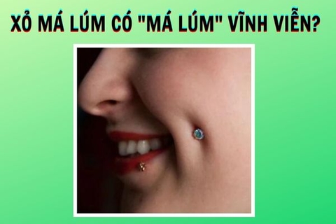 Xỏ khuyên má lúm có để lại má lúm vĩnh viễn không?
