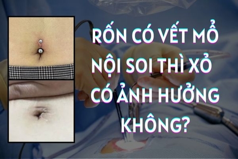 Xỏ khuyên rốn ảnh hưởng đến vết mổ nội soi trước đó không?