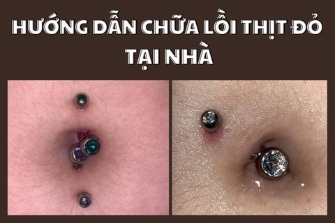 Cách chữa xỏ khuyên rốn bị lồi thịt hiệu quả và đơn giản tại nhà