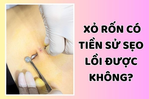 Một số ảnh xỏ khuyên rốn có tiền sử sẹo lồi - Câu chuyện khách hàng