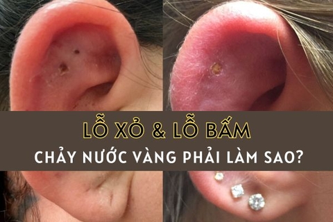 Xỏ khuyên tai bị chảy nước vàng phải làm sao?