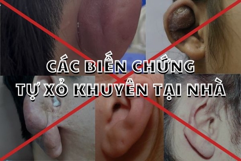 Xỏ khuyên tại nhà và các biến chứng bạn có thể gặp