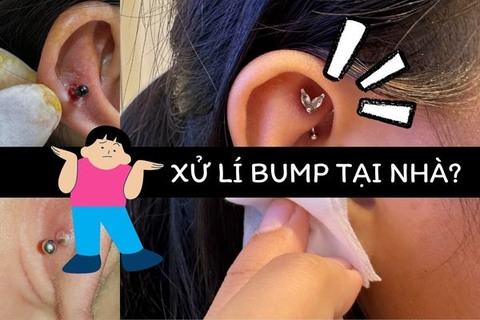 Xử lí lỗ xỏ bị bump tại nhà hiệu quả với 5 bước đơn giản