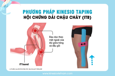 HỘI CHỨNG DẢI CHẬU CHÀY (ITB) -NHỮNG ĐIỀU CÓ THỂ BẠN CHƯA BIẾT