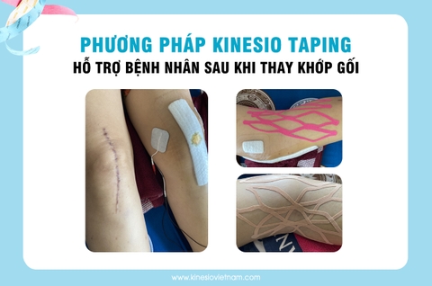 SỰ KHÁC BIỆT GIỮA KHÔNG CAN THIỆP & CAN THIỆP SỚM SAU MỔ