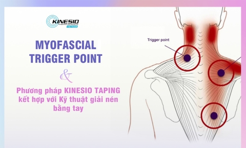 Myofacial Trigger Point và Phương pháp KINESIO TAPING kết hợp với KỸ THUẬT GIẢI NÉN
