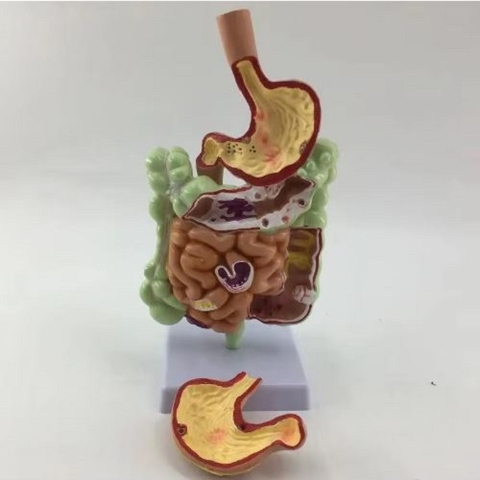 MÔ HÌNH GIẢI PHẪU HỆ TIÊU HÓA – MÔ HÌNH BỆNH LÝ ĐẠI TRÀNG, TRỰC TRÀNG VÀ TÁ TRÀNG