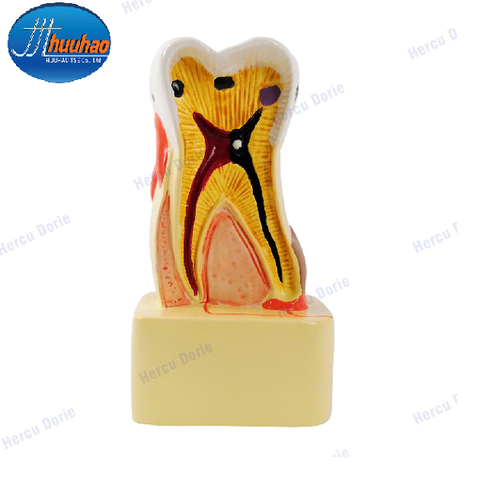 MÔ HÌNH BỆNH LÝ RĂNG HAY GẶP