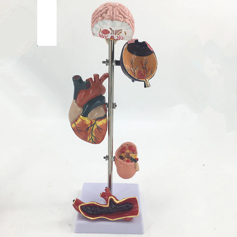 MÔ HÌNH BIẾN CHỨNG CỦA TĂNG HUYẾT ÁP