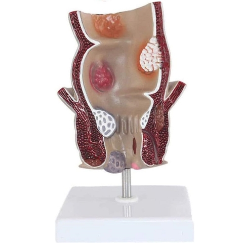 MÔ HÌNH BỆNH LÝ TRĨ, HẬU MÔN, TRỰC TRÀNG