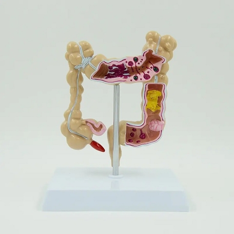 MÔ HÌNH CÁC BỆNH LÝ ĐẠI TRÀNG HAY GẶP (BỆNH LÝ RUỘT GIÀ)