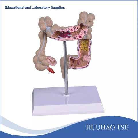 MÔ HÌNH KHUNG ĐẠI TRÀNG VÀ CÁC BỆNH LÝ HAY GẶP
