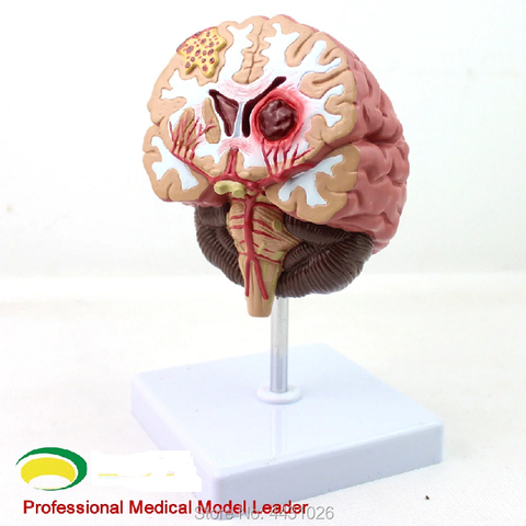 MÔ HÌNH BỆNH LÝ NÃO