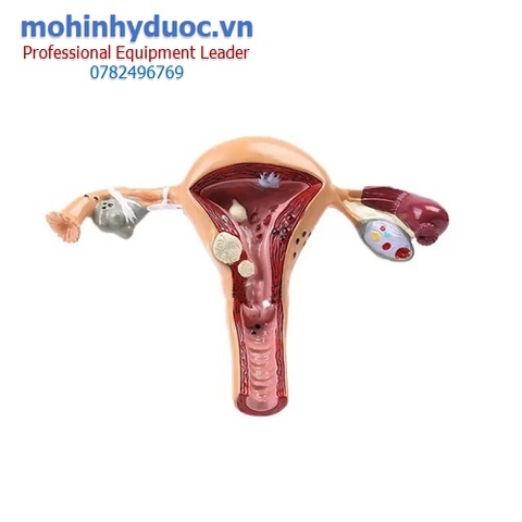 MÔ HÌNH TỬ CUNG - VÒI TRỨNG - BUỒNG TRỨNG BỆNH LÝ