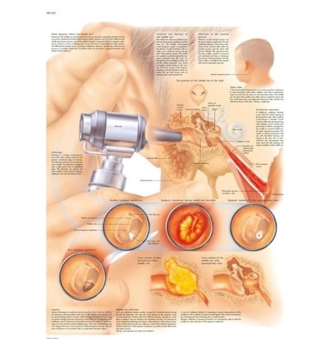 TRANH, BIỂU ĐỒ BỆNH VIÊM TAI GIỮA