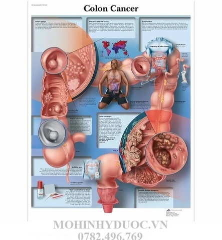 TRANH, BIỂU ĐỒ UNG THƯ RUỘT