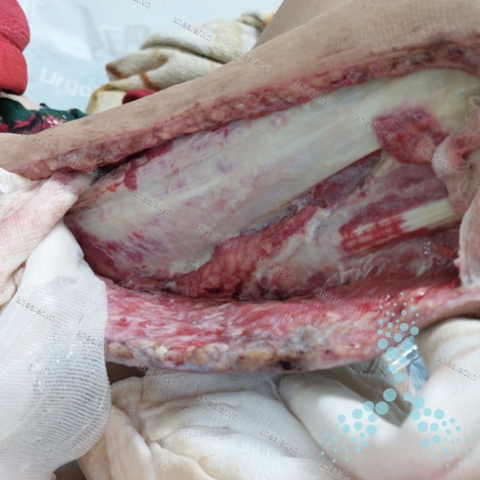 Bảo tồn bàn chân bị loét do đái tháo đường