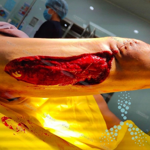Bệnh nhân trẻ khỏe cũng cần nhanh lành vết thương