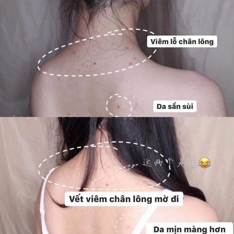 Xịt mụn lưng Angel’s Liquid Glutathion 150ml ( 50ea)