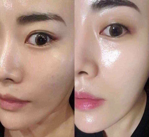 Chỉ tơ tằm esthemax chitossil (52ea)