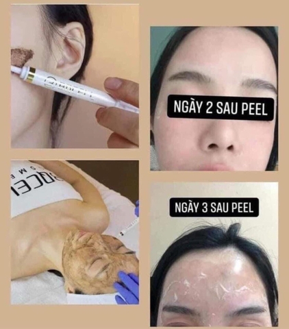 Thay da sinh học BQcell Derma skin peeling (60ea)