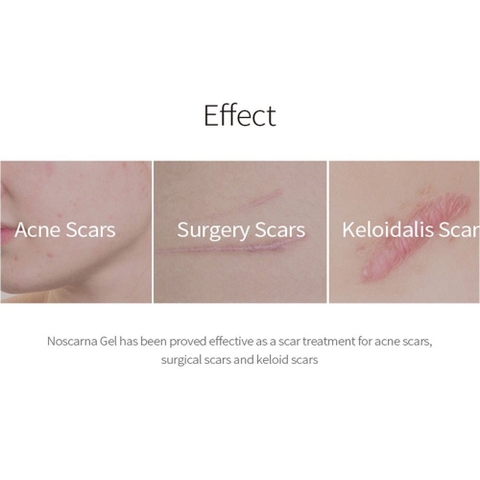 Kem trị sẹo Noscarna  dạng gel 20g (200ea)