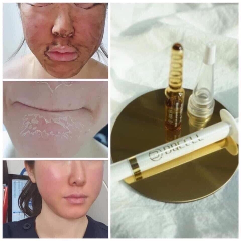 Thay da sinh học BQcell Derma skin peeling (60ea)