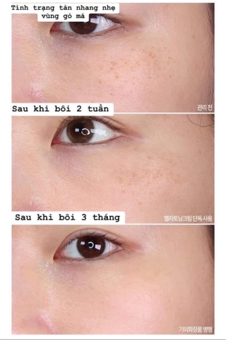 Kem chấm điều trị nám Hydroquinone 2% Hàng hiệu thuốc 동아제약 30g (180ea)