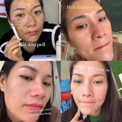 Thay da sinh học BQcell Derma skin peeling (60ea)