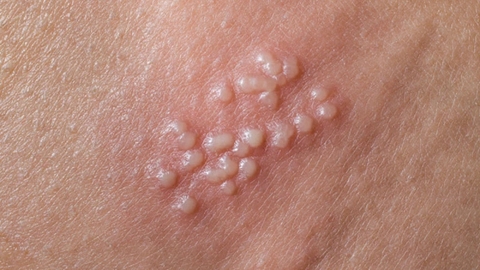 Herpes Sinh Dục: Nguyên Nhân, Triệu Chứng & Điều Trị