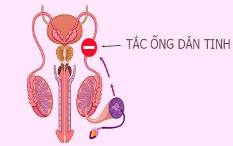 Tắc Ống Dẫn Tinh Kiêng Gì? Những Thói Quen Cần Tránh Để Không Làm Bệnh Nặng Thêm