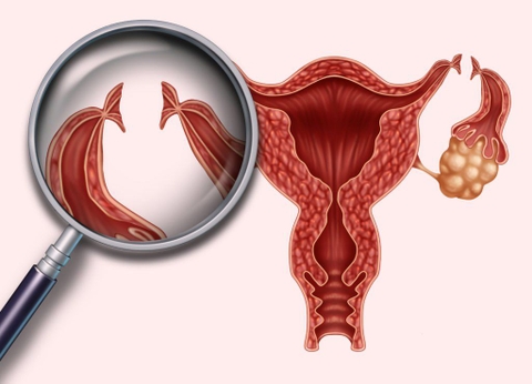 Thắt Ống Dẫn Trứng Là Gì? Lợi Ích, Rủi Ro Và Những Lưu Ý Quan Trọng