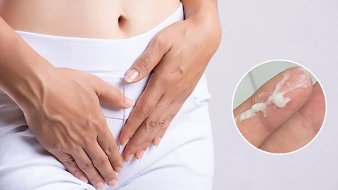 Vùng Kín Có Cặn Trắng Là Gì? Nguyên Nhân Và Cách Xử Lý Đúng Cách