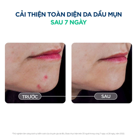 Serum Bioderma Sébium Serum Sáng Mịn, Mờ Thâm Cho Da Dầu Mụn 30ml
