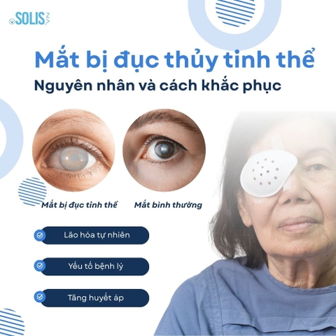 Mắt bị đục thủy tinh thể: Nguyên nhân và cách điều trị