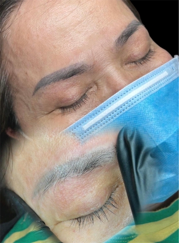 Laser - Xoá Xăm Bằng Laser