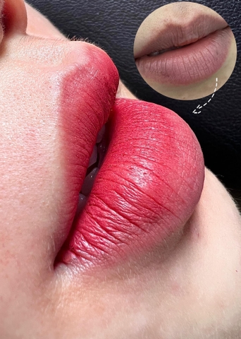 Fixing Botched Lips - Xử Lý Môi Hư (Nữ)