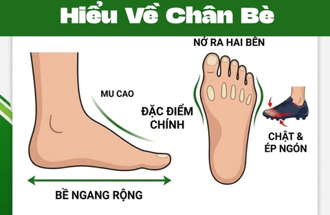 Chân Bè Là Gì? Làm Sao Để Biết Mình Có Bàn Chân Bè?