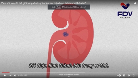 VIÊN SỎI TO NHẤT THẾ GIỚI TỪNG ĐƯỢC GI NHẬN