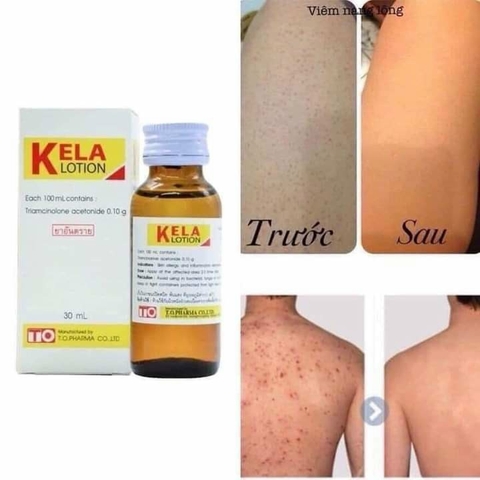[TL]Kem Kela Lotion Đặc Trị Viêm Da, Viêm Nang Lông 30ml
