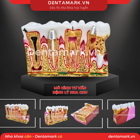 Mô hình tư vấn bệnh lý nha chu - Nội nha M4019