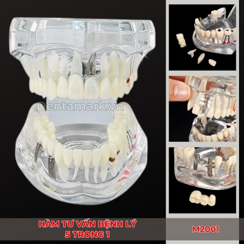 Hàm tư vấn bệnh lý, cầu răng, implant trong nha khoa - Hàm tư vấn 5 in 1