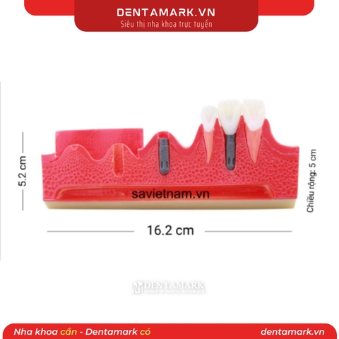 Hàm tư vấn các bước cắm Implant