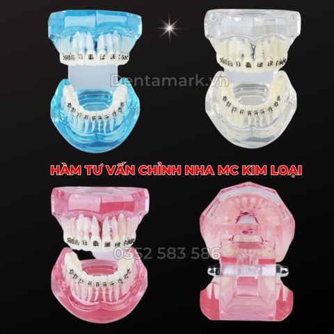 Hàm tư vấn chỉnh nha mắc cài kim loại