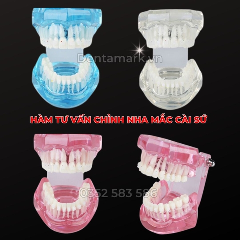 Hàm tư vấn chỉnh nha mắc cài sứ